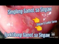 Yelo Gamot Sa Singaw